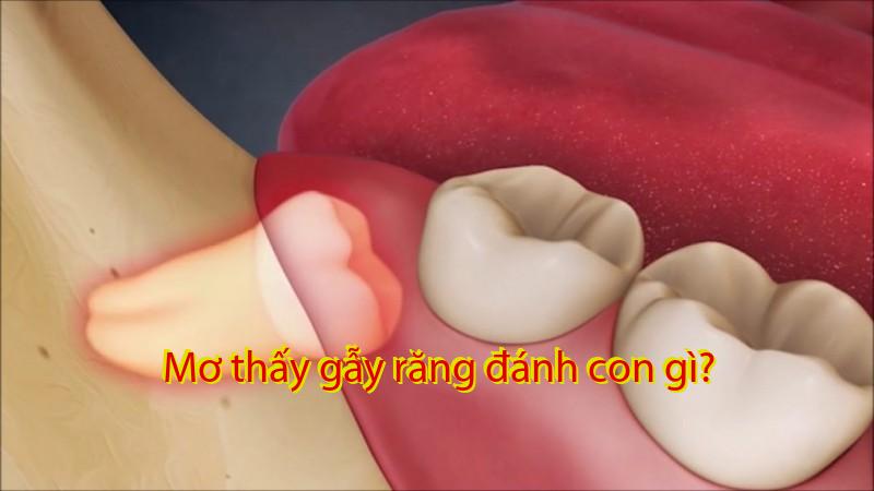 Mơ thấy gẫy răng đánh con gì?